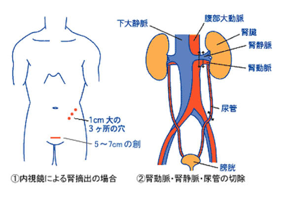 ドナーの手術（腹腔鏡下腎採取術）